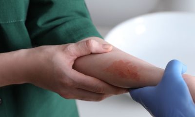 Burns and Infection Understanding the Risk Factors and Preventive Strategies