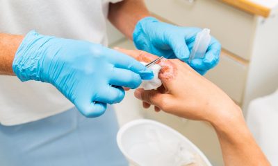 Burn Wound Care: Proper Techniques