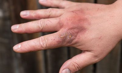 Long-term Complications and Rehabilitation of Skin Burns