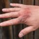 Long-term Complications and Rehabilitation of Skin Burns