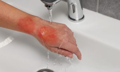 Pain Management: Managing Pain Associated With Burns