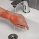 Pain Management: Managing Pain Associated With Burns