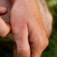 Bee Sting Allergy: First Aid Protocol