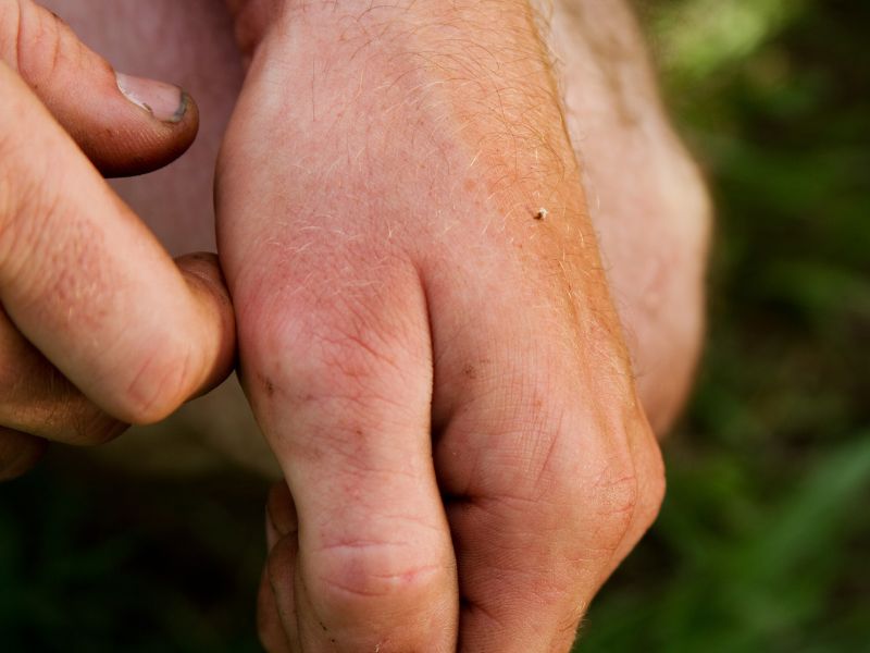 Bee Sting Allergy: First Aid Protocol