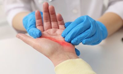 Innovative Home Care Solutions for Burn Patients