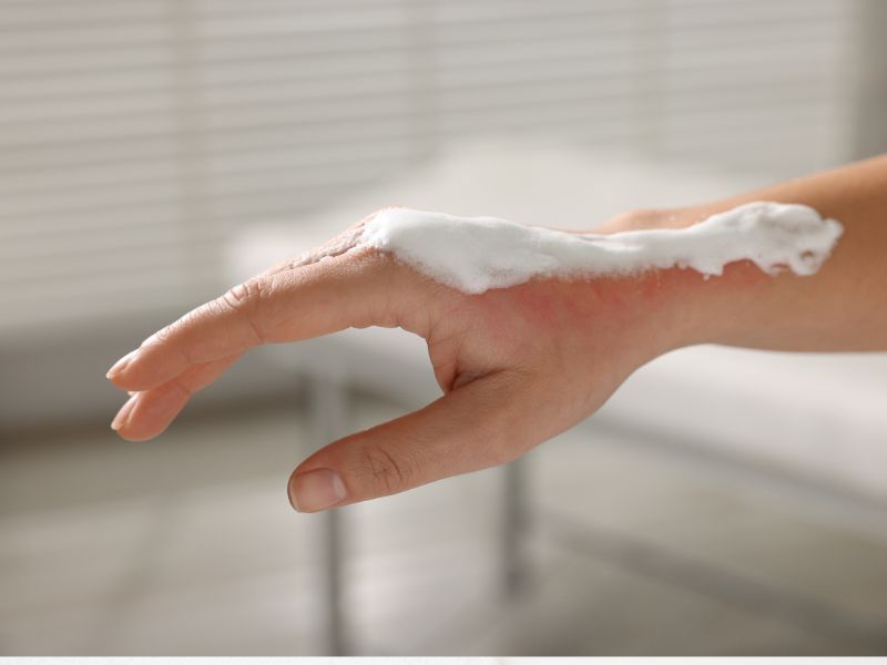Personalized Medicine in Burn Care: A Growing Trend