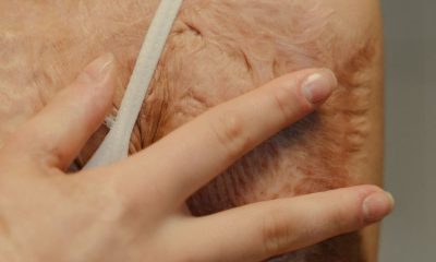 Psychological Support for Burn Survivors: Emerging Trends