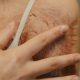 Psychological Support for Burn Survivors: Emerging Trends