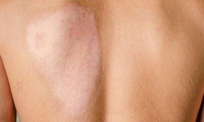 Regenerative Medicine and Its Role in Burn Recovery