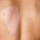 Regenerative Medicine and Its Role in Burn Recovery