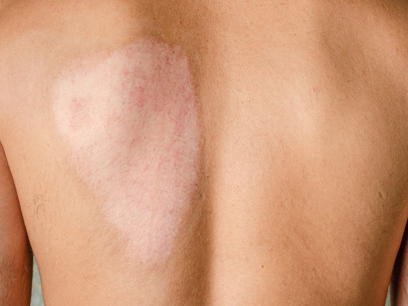 Regenerative Medicine and Its Role in Burn Recovery