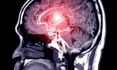 First Aid Techniques to Help Stroke Victims Quickly and Effectively
