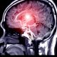 First Aid Techniques to Help Stroke Victims Quickly and Effectively