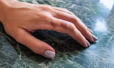 Emergency Burn Care: What to Do for Minor Burns