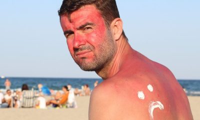 Sunburn First Aid: Quick Relief and Healing Tips