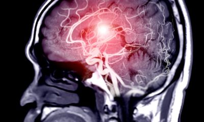Your Quick Reference for First Aid in Stroke Cases