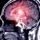 Your Quick Reference for First Aid in Stroke Cases