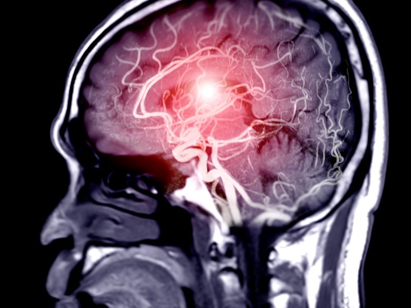 Your Quick Reference for First Aid in Stroke Cases