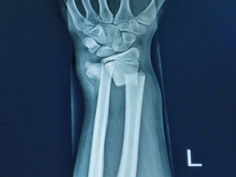 Broken Bones: Immobilization Techniques in First Aid