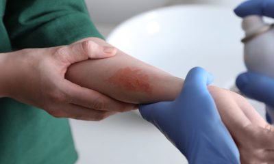 Essential First Aid Steps for Treating Home Burns