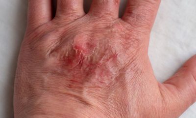 Healing Burn Wounds: Accelerating Recovery Safely