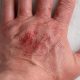 Healing Burn Wounds: Accelerating Recovery Safely