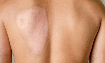 Long-Term Care for Burn Scars: Preventing Complications