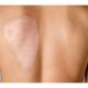 Long-Term Care for Burn Scars: Preventing Complications