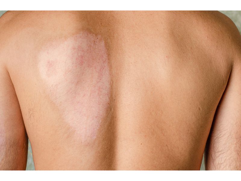Long-Term Care for Burn Scars: Preventing Complications