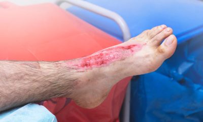 When to Seek Professional Help for a Burn Injury