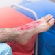 When to Seek Professional Help for a Burn Injury