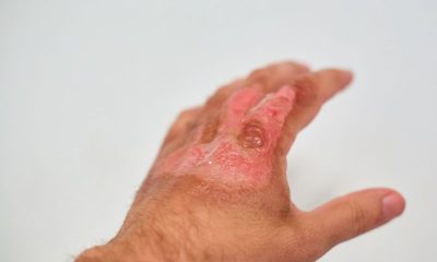 First Aid Poisoning: Differences Between Acid and Alkaline Burns