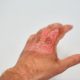 First Aid Poisoning: Differences Between Acid and Alkaline Burns