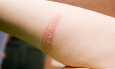Common Mistakes to Avoid in First-Degree Burn Treatment