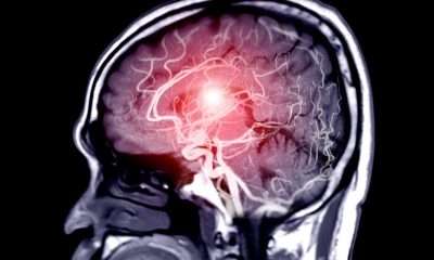 Minimizing Brain Damage With Effective Stroke First Aid