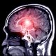 Minimizing Brain Damage With Effective Stroke First Aid