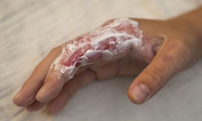 Addressing Burn Shock: Immediate First Aid Measures