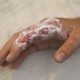 Addressing Burn Shock: Immediate First Aid Measures