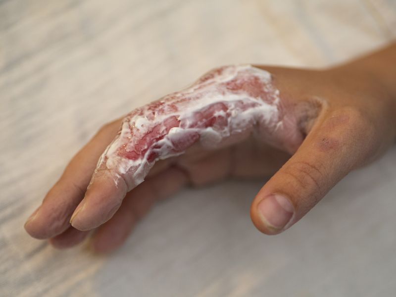 Addressing Burn Shock: Immediate First Aid Measures