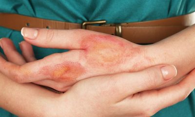 First Aid Guide to Effectively Dealing With Skin Burns