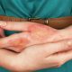 First Aid Guide to Effectively Dealing With Skin Burns