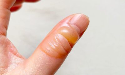 First Aid Tips for Common Burns During Backyard Grilling