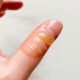 First Aid Tips for Common Burns During Backyard Grilling
