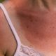 Sunburn First Aid: Immediate Care and Long-Term Skin Health