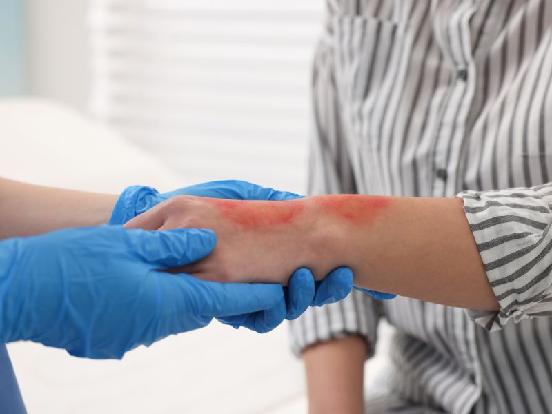 The Role of First Aid in Preventing Burn-Related Infections