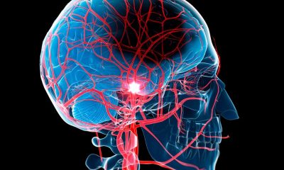 Stroke Victims and the Golden Hour of Response Time
