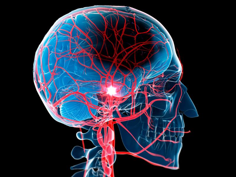 Stroke Victims and the Golden Hour of Response Time