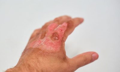 Dealing With Oil-Related Skin Burns at Home