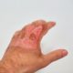 Dealing With Oil-Related Skin Burns at Home
