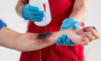 Dealing With Severe Skin Burns Before Medical Help